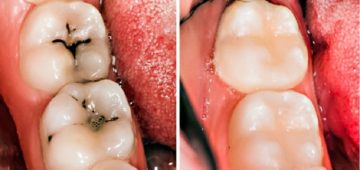 how to prevent tooth decay naturally